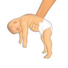 Image result for Floppy Infant