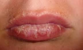 They can be applied to your lips, nose and cheeks if. How To Treat Sunburnt Lips Fast What Not To Do Read This First