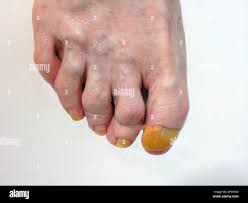 Image result for Onychogryphosis feet