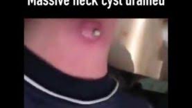 The dogs preferred not to take food from a stranger who refused help. Satisfying Pimple Popping Cyst Blackhead Acne Whitehead Zit Try Not To Look Away Or Watch Pimple Popping Videos