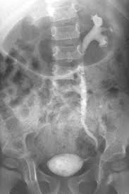 Image result for Voiding Cystourethrogram