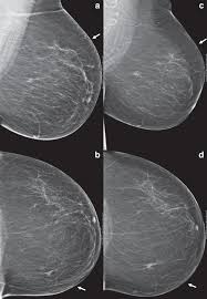 A mammogram can show breast changes such as calcifications, masses, or other symptoms that might be cancer. Delayed Breast Cancer Diagnosis After Repeated Recall At Biennial Screening Mammography An Observational Follow Up Study From The Netherlands British Journal Of Cancer
