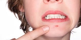 Bir Gunde Sivilce Nasil Gecer