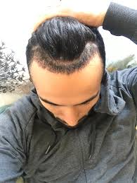 Reorganizing our healthy hair follicles to cosmetically cover our pattern hair loss. Iqbals Hair Transplant In Turkey The Process And The Successful Result