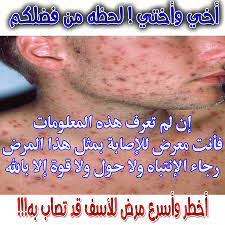 كيف اكتشف مرض الايدز اعراض الايدز وكيفيه اكتشافه وعلاجه احضان الحب