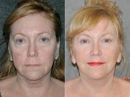 Plastic Surgery Face Lift Beverly Hills Celebrity Plastic Surgery Plastic Surgery Plastic And Reconstructive Surgery