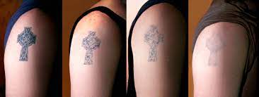 Tattoo removal patient and esthetician joanna stella miami beach. Tattoo Removal Miami Salvation Tattoo Lounge