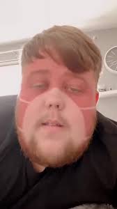 Unbelievable Sunburn Fail Caught