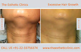 In this video dr preeti saraswat discusses the reasons for excessive hair growth in females.dr preeti saraswat is a senior doctor at saraswat hospital and. Excessive Hair Growth Removal Treatment Cost In Mumbai India The Esthetic Clinics