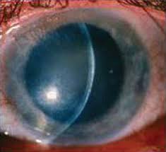 Due to immune reaction within the stroma; Eyeworld Tips For Steroid Use In Hsv