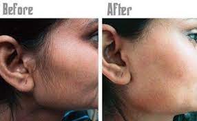 2 Ayurvedic Herbs That Can Stop Unwanted Hair Growth Remove Facial Hair Naturally How To Remove Facial Hair Naturally Unwanted Hair Growth