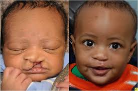 Study results provide prospective evidence to support postoperative observation of children by surgery staff and family following cleft lip or cleft palate repair without the use of elbow restraints. Cleft Lip And Cleft Palate Johns Hopkins Facial Plastic And Reconstructive Surgery