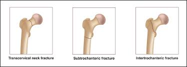 Image result for Fracture
