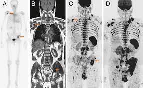 If you've received a diagnosis, here are some things you need to know about the condition. Can Whole Body Magnetic Resonance Imaging With Diffusion Weighted Imaging Replace Tc 99m Bone Scanning And Computed Tomography For Single Step Detection Of Metastases In Patients With High Risk Prostate Cancer European Urology