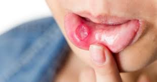 Image result for Puchýře na jazyku