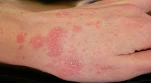 Baca lebih lanjut dengan klik pada link ini! Ingatkan Kudis Biasa Tak Sangka Boleh Rosakkan Buah Pinggang Ini Penjelasan Doktor