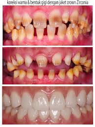 Jacket Crown Zirconia Dental Wallpaper Restorative Dentistry Dental Cosmetics
