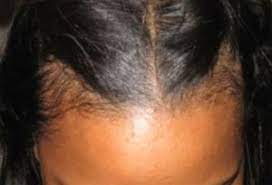 Postpartum hair fall is the most natural phenomenon of your body. Hair Loss Post Pregnancy Hair Experts Swinfen Salon