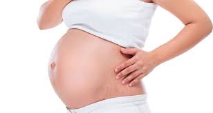 What causes tiger stripes on skin. Natural Remedies For Pregnancy Stretch Marks