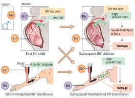 Maternal Rhesus Isoimmunization Rh Incompatibility Medchrome