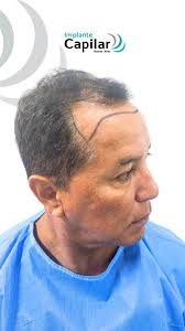 Un equipo de profesionales a tu disposición 🙌💉 En @implantecapilar.bsas  estamos para ayudarte Pedí tu próximo turno ↪️ 115464-6839📲  #implantecapilarbuenosaires #caba #estética #facial #medicina #mujeres  #bienestar #contornofacial #salud ...