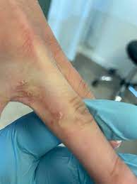 De schurftmijt is een spinachtig diertje dat niet met het blote oog te zien is. Scabies Dermatwente