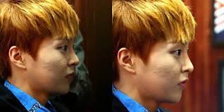 10 Idols Who Battled Acne Acne Clear Complexion Acne Tool