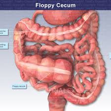 Pdf) Surgery To Treat Symptomatic Mobile Cecum Syndrome Is Safe And  Associated With Good Recovery Outcomes
