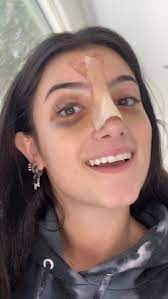 Pin By Rebecca Mensah On Tiktoks Nose Job Rhinoplasty Nose Jobs Nose Problems
