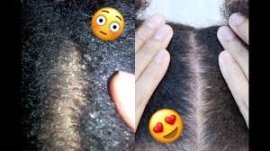 Managing stressin healthy ways 3. How I Cured My Extremely Dry Scalp Youtube