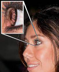 Is it normal to have blue ring around the eyes? Why Do Some People Have Dark Rings Around The Iris Of Their Eye Bellatory