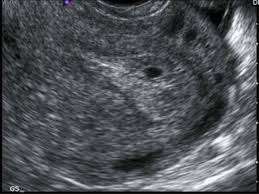 Image result for First Trimester Ultrasound