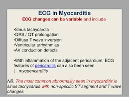 With inflammation of the adjacent pericardium, ecg features of pericarditis can also been. Myocarditis