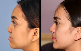 Sometimes babies will feed from a special tendercare™ feeder or from a syringe with brecht® tubing for the first few days after surgery. Cleft Lip Revision Rhinoplasty Can Restore Confidence For Teens And Adults Pediatrics Plastic Surgery Ut Southwestern Medical Center