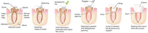 During a root canal procedure, the nerve and pulp of the tooth are removed and the inside is cleaned and sealed. Root Canal Guide On Root Canal Treatment Prices Procedure Photos