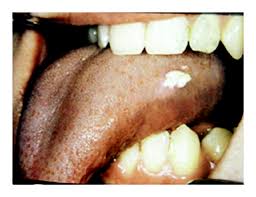 Image result for papillomavirus tongue)