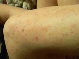 Birthmark On Leg Meaning In Hindi I Like Legs Better With Razor Burn Razor Burns Bikini Area Razor Bumps