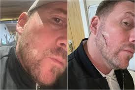 Homem que tentou esconder “pelo encravado” com barba descobre câncer