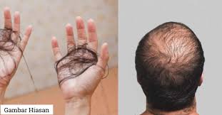 Sebelum kita bercerita mengenai petua untuk mengelakkan rambut gugur, kita perlu ambil peduli. Punca Rambut Gugur Bertompok