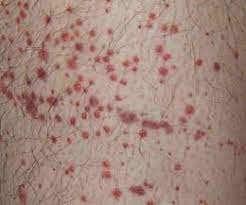 Malattia autoimmune acquisita caratterizzata da penuria di piastrine dovuta alla loro distruzione in periferia. Porpora Trombocitopenica Immune Wikipedia