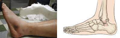 Sprained Ankle - Orthoinfo - Aaos