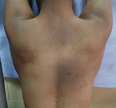 Image result for Diffuse Hyperpigmentation