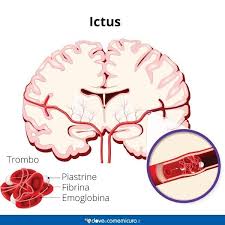 Le emorragie cerebrali possono essere mortali. Ictus Cerebrale E Afasia Prevenzione Comunicazione E Riabilitazione