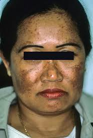Image result for Melasma