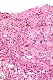 The accuracy of the pathological diagnosis is very important to the patients because they can be receive official compensation or relief when the diagnosis of. Malignant Mesothelioma Libre Pathology