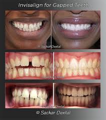During invisalign treatment, your jawbone would have softened or disappeared (a process called resorption) so teeth could move into their final positions. How Many Hours To Wear Retainer After Invisalign