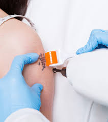 And for per treatment, you will need. 5 Best Laser Tattoo Removal Techniques Available In India