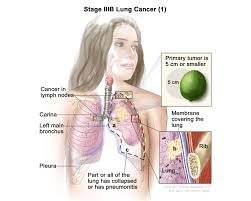 Image result for Lung Cancer