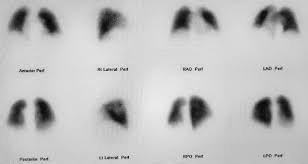 Image result for Ventilation Perfusion Scan