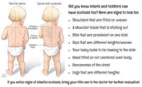 15% are congenital and 10% are. Scoliosis Advocacy Network Posts Facebook